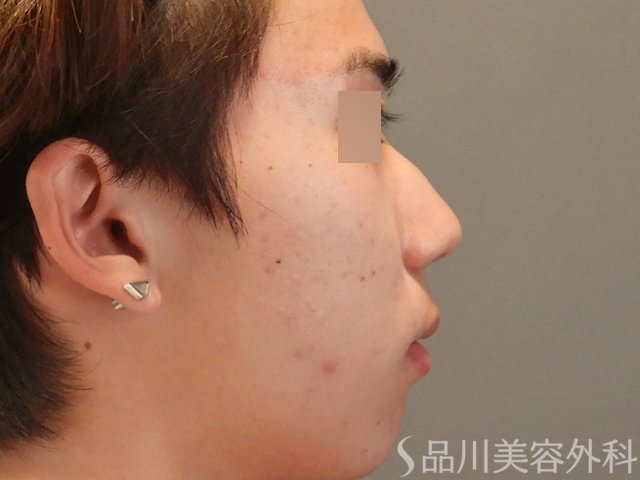 症例NO.74879のBEFORE写真