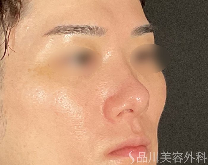 症例NO.75114のBEFORE写真