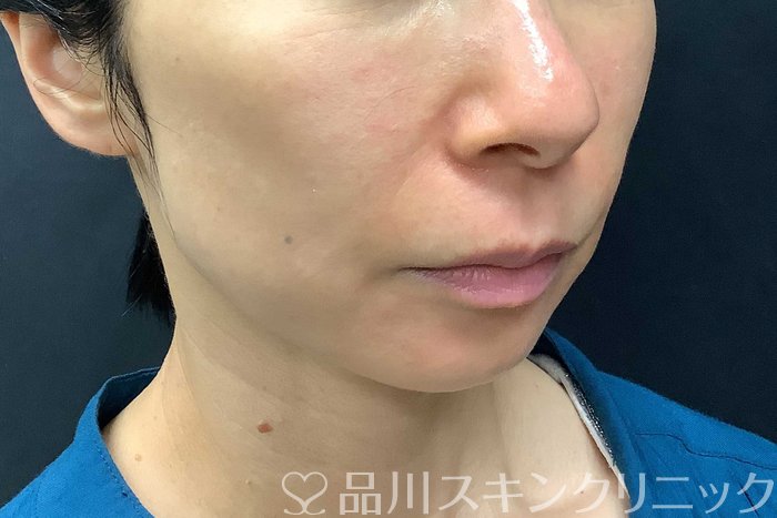 症例NO.69840のAFTER写真