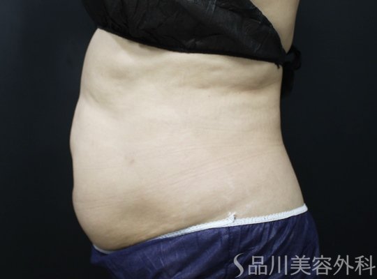 症例NO.75372のAFTER写真