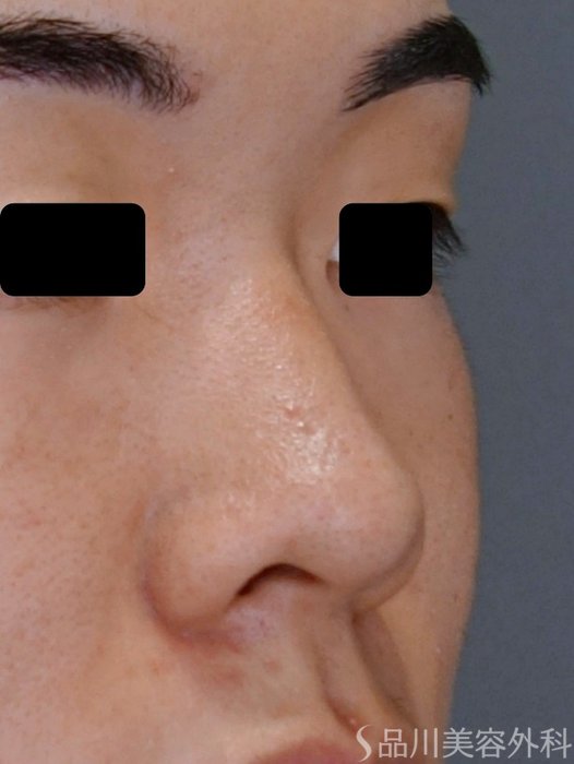 症例NO.74497のBEFORE写真