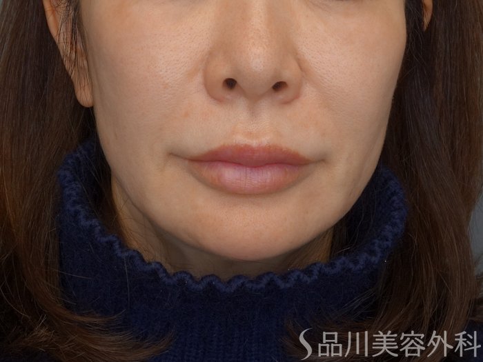 症例NO.74716のBEFORE写真