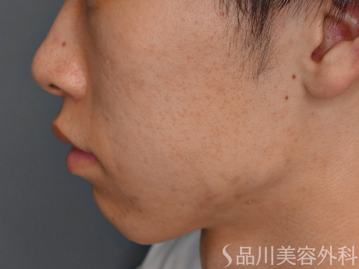 症例NO.73514のBEFORE写真