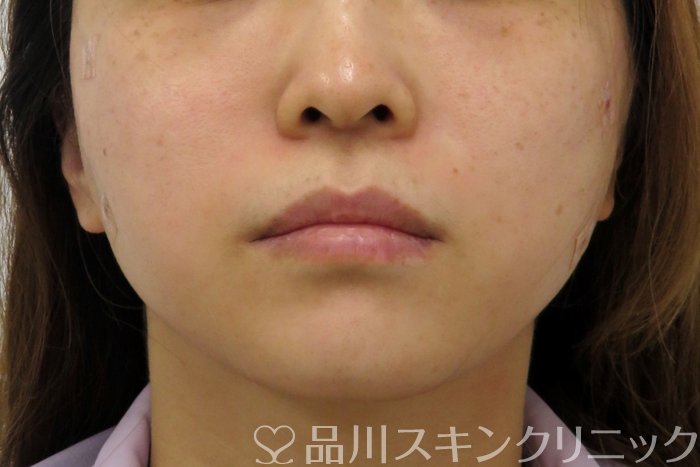 症例NO.74817のAFTER写真