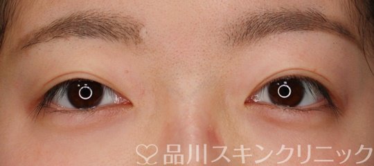 症例NO.70591のBEFORE写真