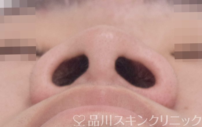 症例NO.62910のBEFORE写真