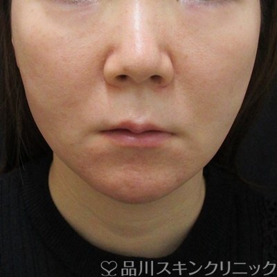 症例NO.69982のAFTER写真