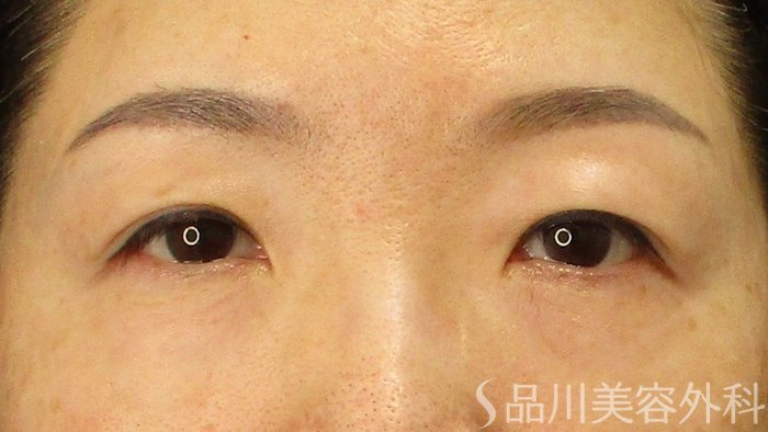 症例NO.73147のBEFORE写真