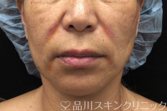 症例NO.74606のBEFORE写真