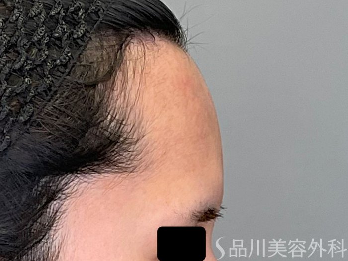 症例NO.71043のAFTER写真