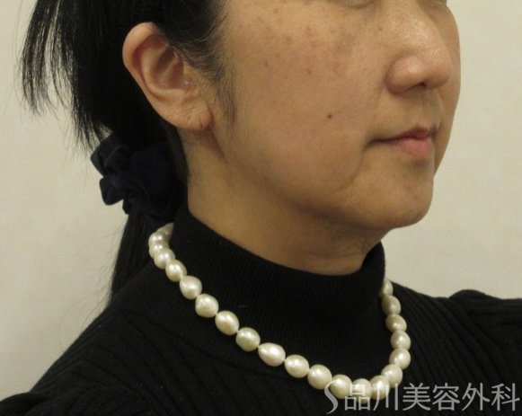 症例NO.72548のBEFORE写真