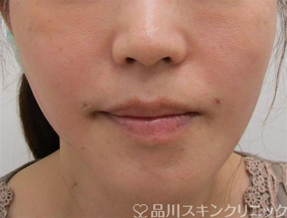 症例NO.37351のAFTER写真