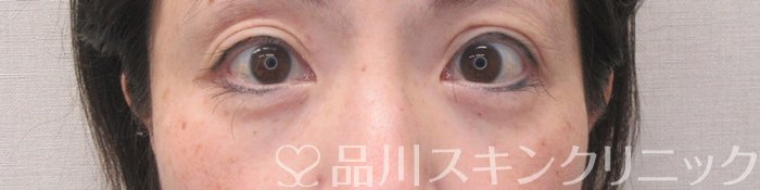 症例NO.69974のAFTER写真
