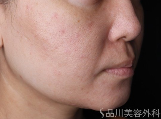 症例NO.67692のBEFORE写真