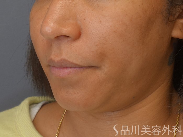 症例NO.74733のBEFORE写真