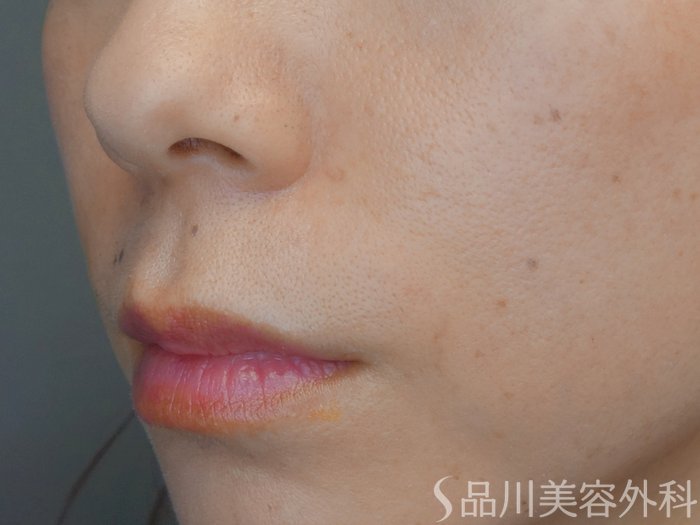 症例NO.71432のAFTER写真