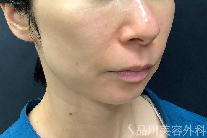 症例NO.69840のAFTER写真