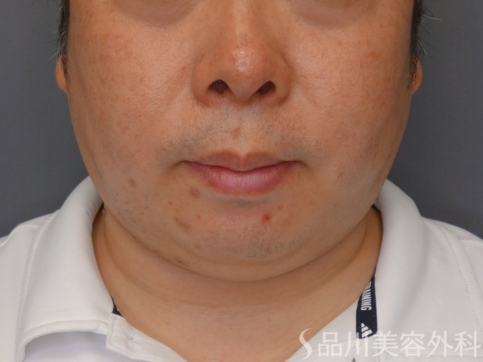 症例NO.75035のBEFORE写真