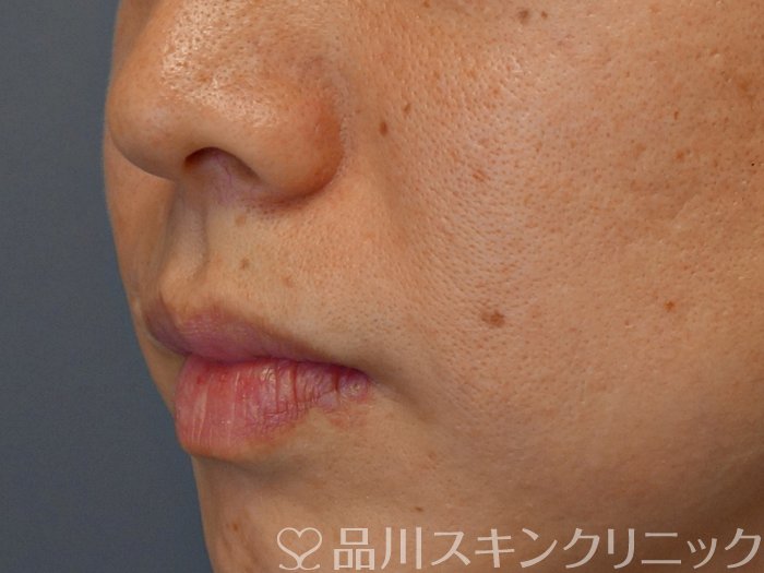 症例NO.72120のBEFORE写真