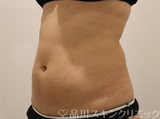 症例NO.73502のAFTER写真