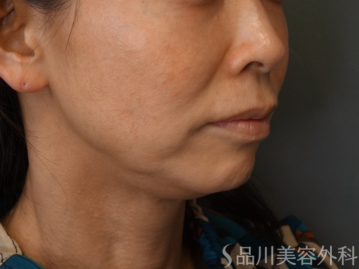 症例NO.74710のBEFORE写真