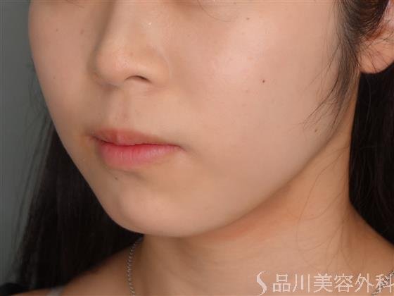 症例NO.54188のAFTER写真