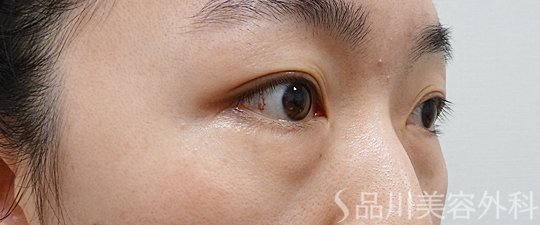 症例NO.69882のBEFORE写真