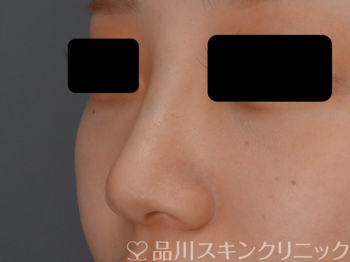 症例NO.70949のAFTER写真