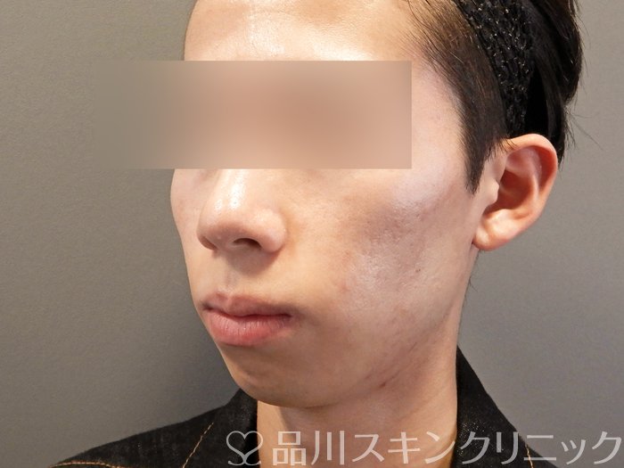 症例NO.68375のAFTER写真