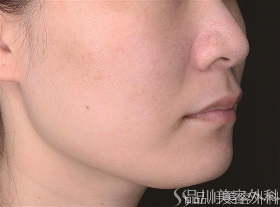 症例NO.65361のAFTER写真