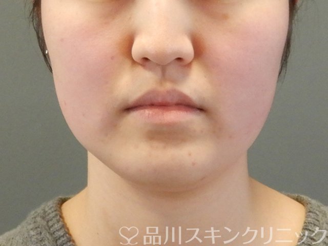 症例NO.64240のBEFORE写真