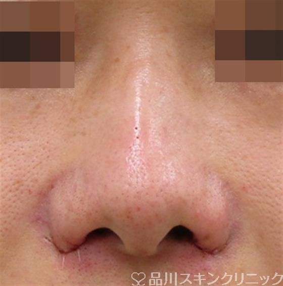 症例NO.38475のAFTER写真