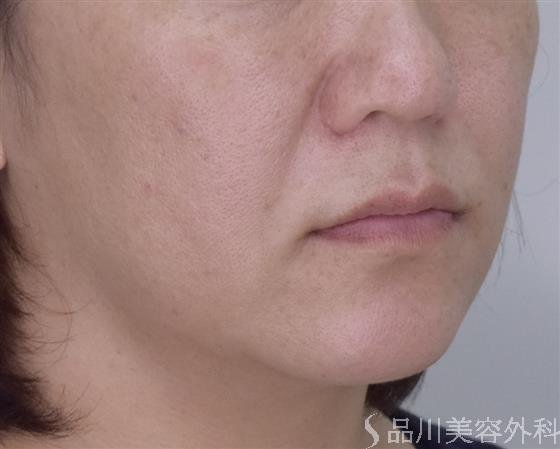 症例NO.50469のBEFORE写真