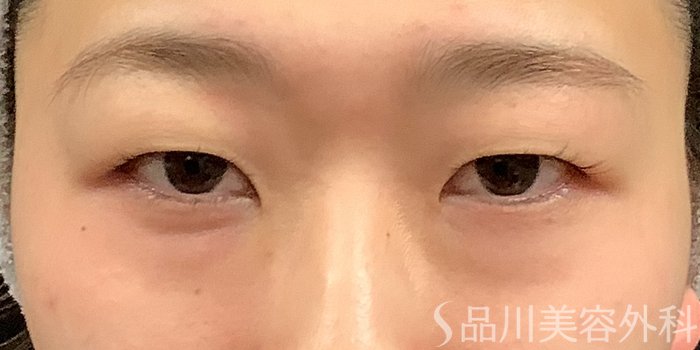 症例NO.71231のBEFORE写真