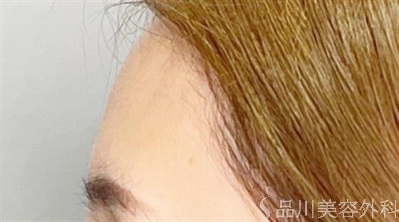 症例NO.52525のBEFORE写真