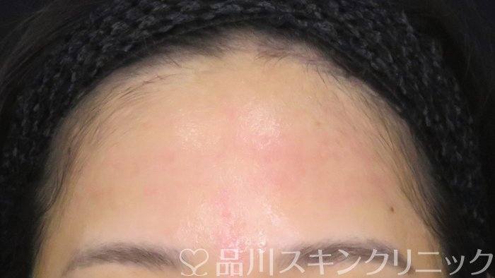 症例NO.70862のBEFORE写真