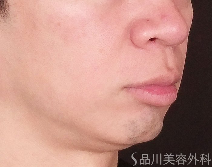 症例NO.71766のBEFORE写真