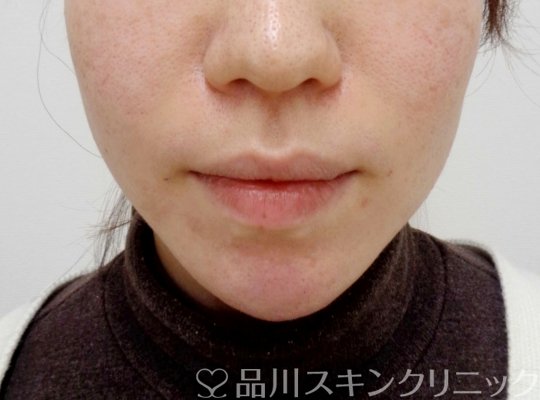 症例NO.65419のAFTER写真