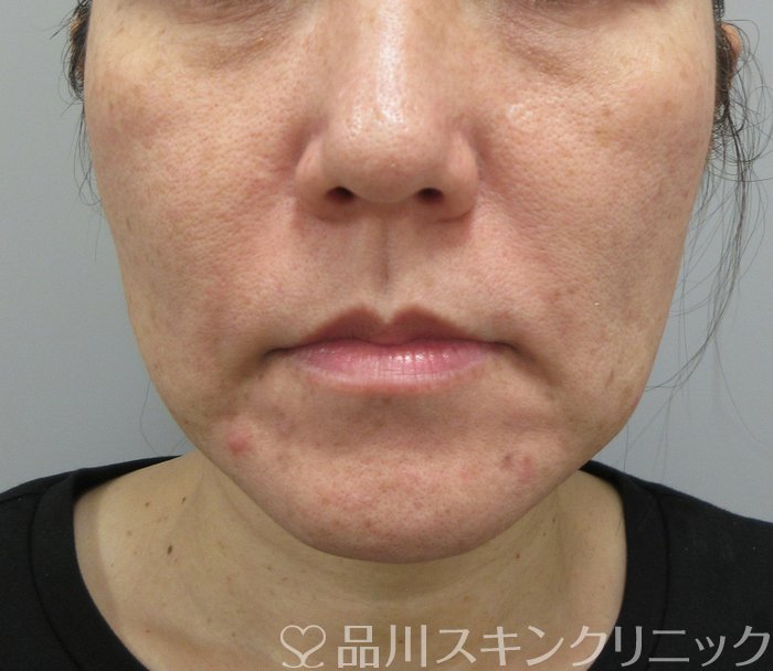 症例NO.73644のBEFORE写真