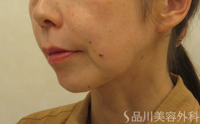 症例NO.71711のBEFORE写真