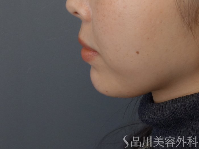 症例NO.72601のAFTER写真