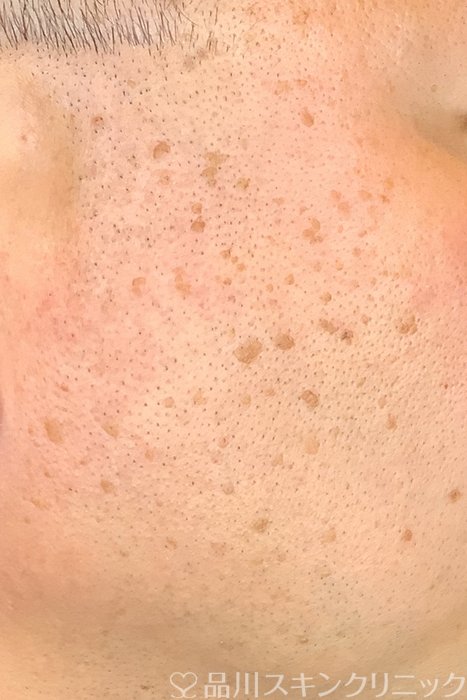 症例NO.69487のBEFORE写真