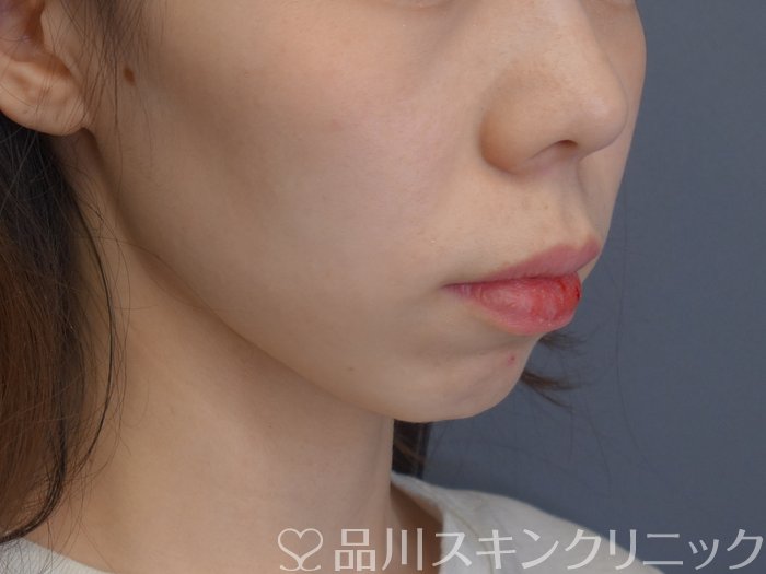 症例NO.74550のBEFORE写真