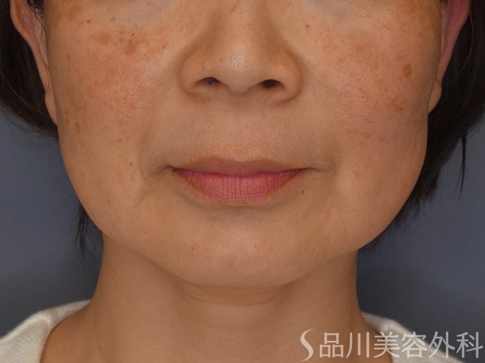 症例NO.68164のBEFORE写真