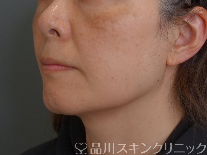 症例NO.74280のBEFORE写真