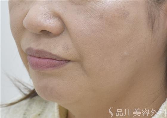症例NO.47630のBEFORE写真