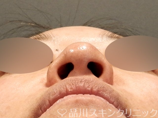 症例NO.68613のBEFORE写真