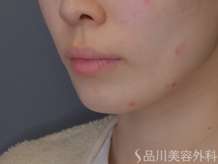 症例NO.72317のBEFORE写真