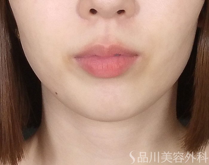 症例NO.65675のAFTER写真