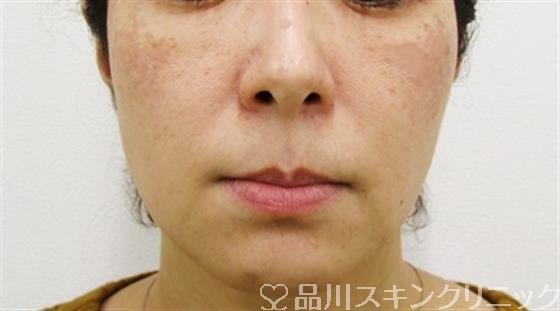 症例NO.49247のBEFORE写真